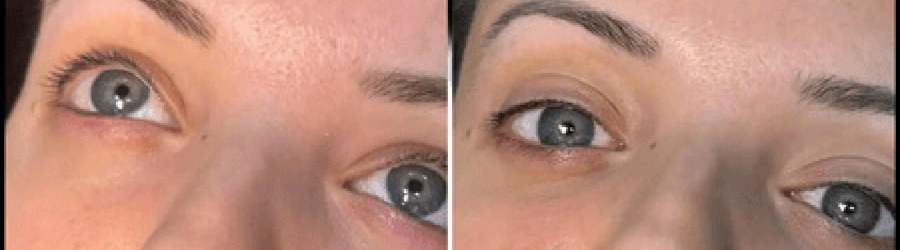 Dermal Fillers